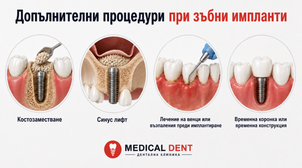 Схема на допълнителни процедури при поставяне на зъбни импланти
